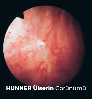 Appearance of Hunner's ulcer