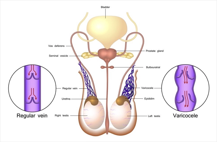 Kronik Testis Ağrısı: Lokal (Skrotal/Testiküler) Nedenler