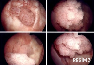 Mesane Kanseri Nedir?