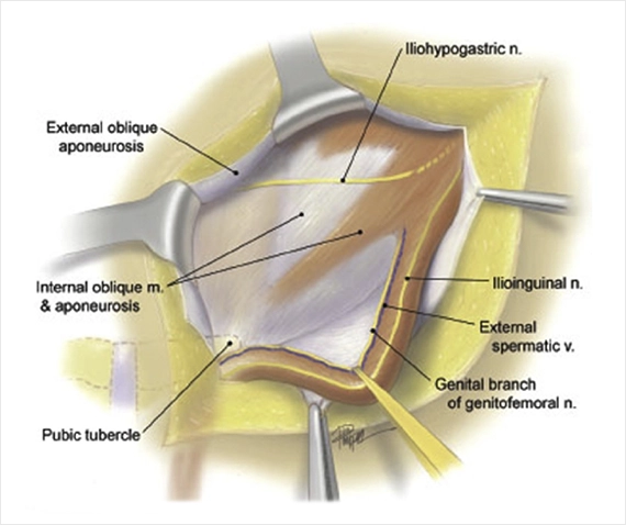 Kronik Testis Ağrısı: Nöropatik Ağrılar