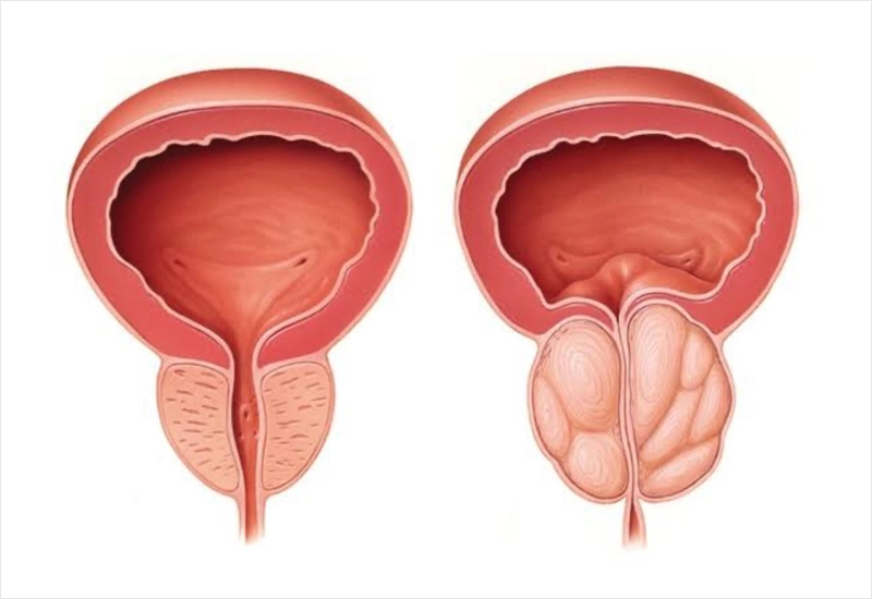 Prostat TUR (TUR-P) Ameliyatı Ankara