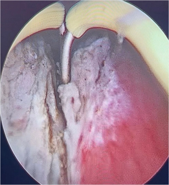 Tuip Ameliyatı Ankara