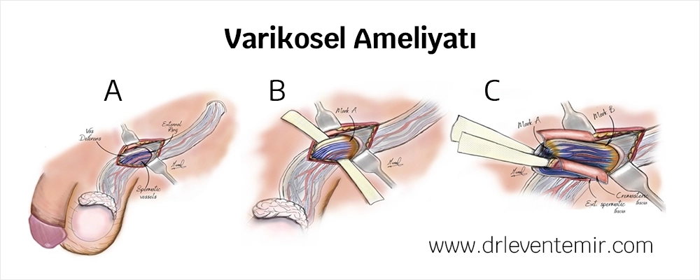 Varikosel Ameliyatı