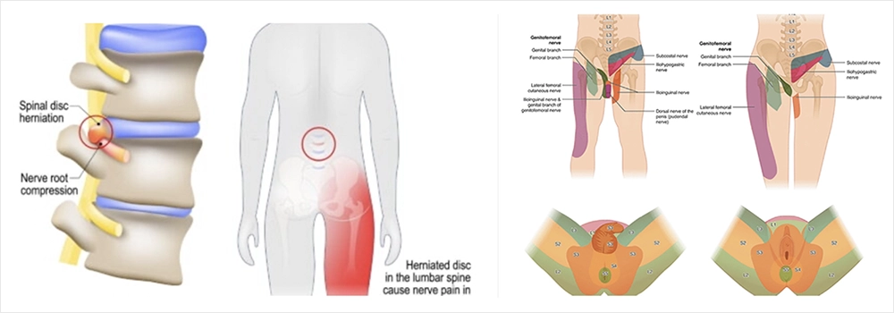 Yansıyan Ağrı: Kronik Testis Ağrısı